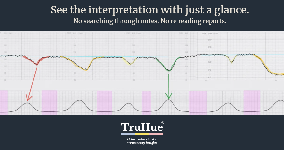 Color-coded fetal monitoring tracing showing how TruHue® makes the interpretation visible at a glance